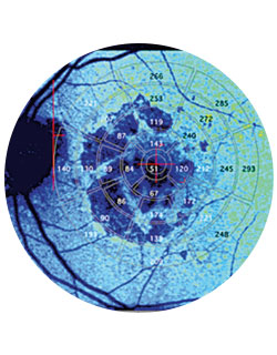 A quantitative autofluorescence image of a patient with kidney disease and advanced macular degeneration with geographic atrophy, seen as dark lobes in the center of the measurement grid. The autofluorescence levels are much lower here.
