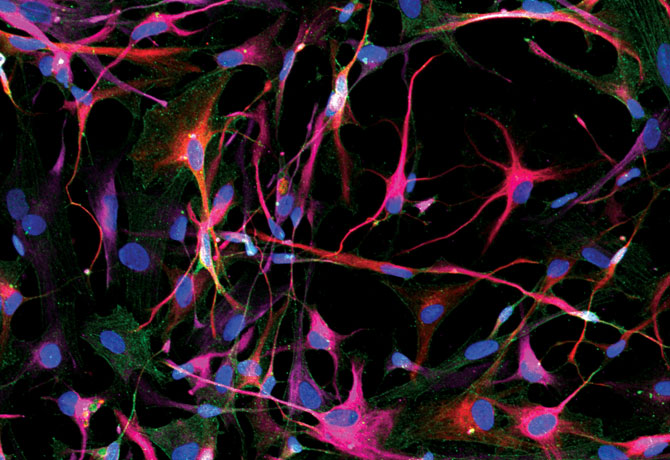 Image showing homogeneous population of human astrocytes co-express astrocyte specific markers, glial fibrillary acidic protein (GFAP: red), and S100 calcium-binding protein B (S100B: pink) intracellularly, and glutamate aspartate transporter on the cell surface. Co-expression of GFAP and S100B displays high-intensity magenta, and nuclei are visualized by DAPI (blue). Credit: Julia TCW, PhD, Postdoctoral Fellow, Goate Laboratory