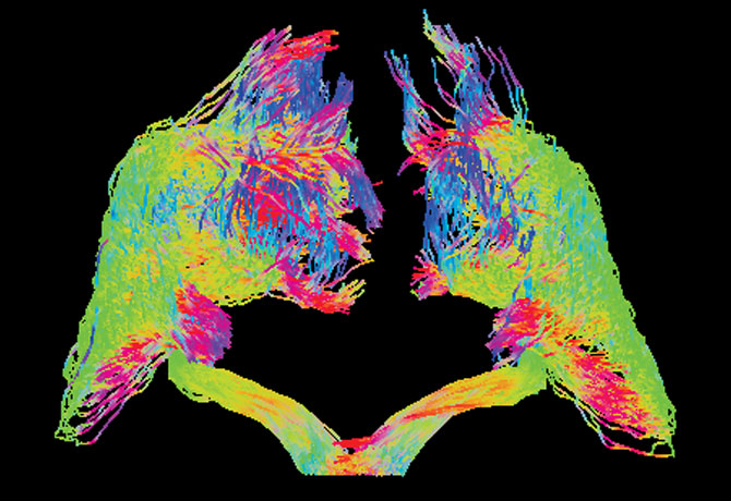 3-dimensional rendering of probabilistic tractography of the optic tracts and radiations from diffusion MRI data obtained from human subjects at 7 Tesla. Credit: Jack Rutland, Icahn School of Medicine at Mount Sinai student, Balchandani Laboratory