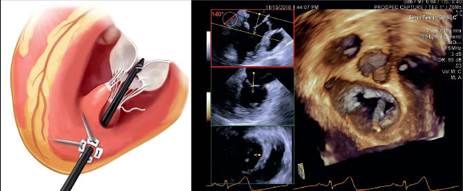 The NeoChord device, show in illustration, is inserted in the beating heart through a small incision, guided by echocardiography, shown in image.